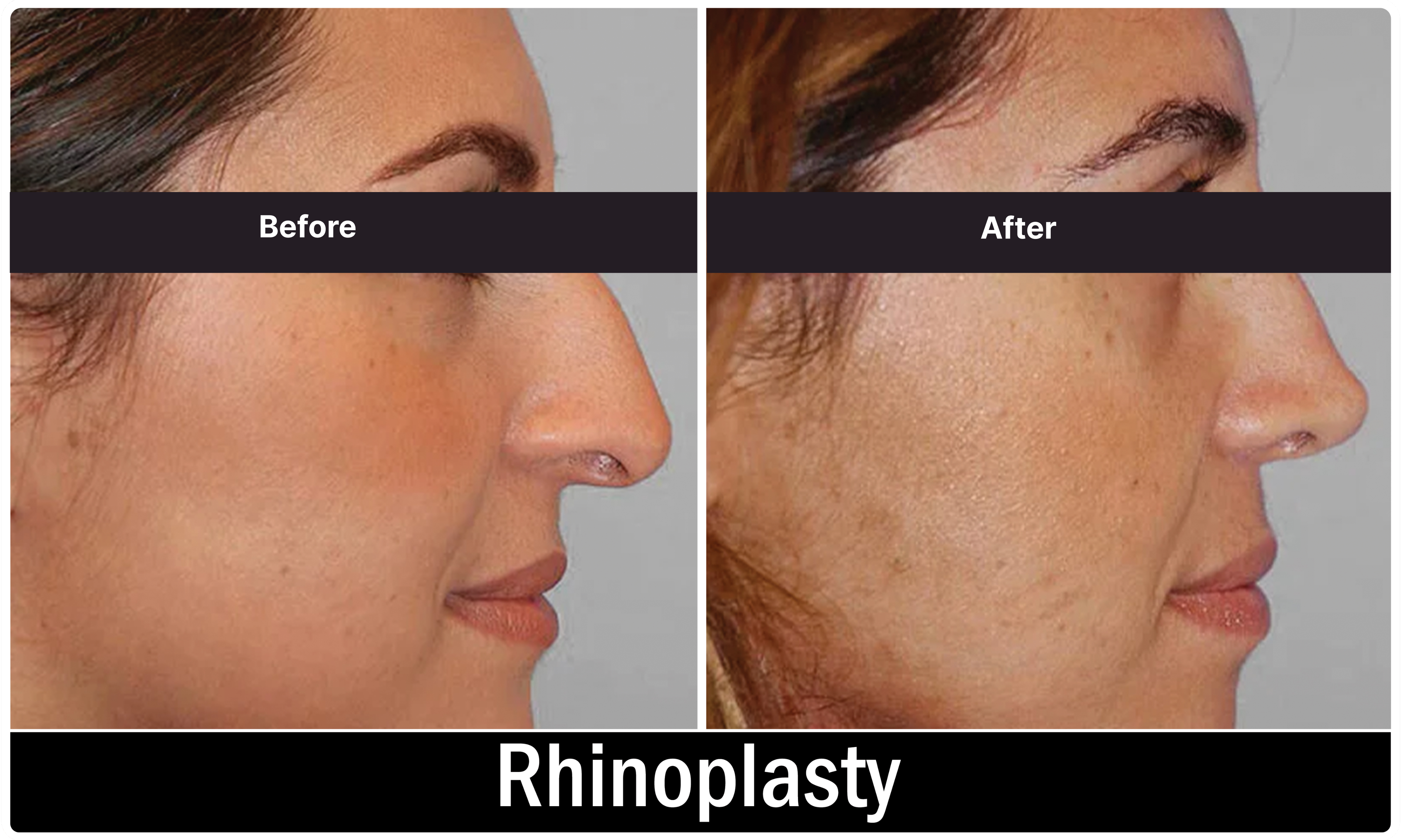 Alar Reduction result KOQ10